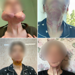 В областной больнице женщине восстановили лицо после сильного ожога